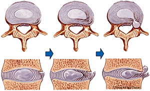 Dischi invertebrali