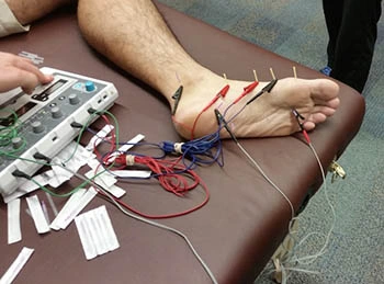 Il Dry Needling è una terapia minimamente invasiva e comporta un basso o assente rischio, se usata da mani esperte.  