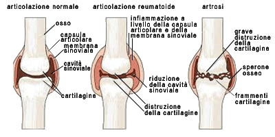 Osteoartrosi Osteoartrosi