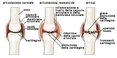 Osteoartrosi