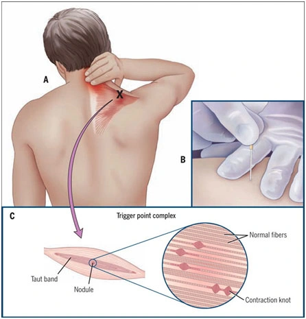 Il Dry Needling è una tecnica manuale iniettiva, totalmente indolore, utilizzata per il trattamento del dolore miofasciale