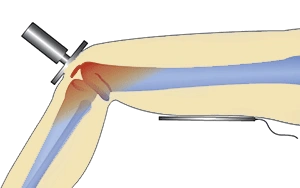 Metodi di applicazione della tecarterapia Metodi di applicazione della tecarterapia